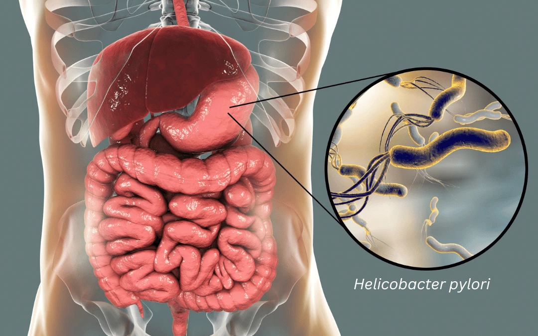 Illustration Of Human Body Showing Digestive System And Up Close Of Stomach With Helicobacter Pylori Bacteria Pointing In The Stomach