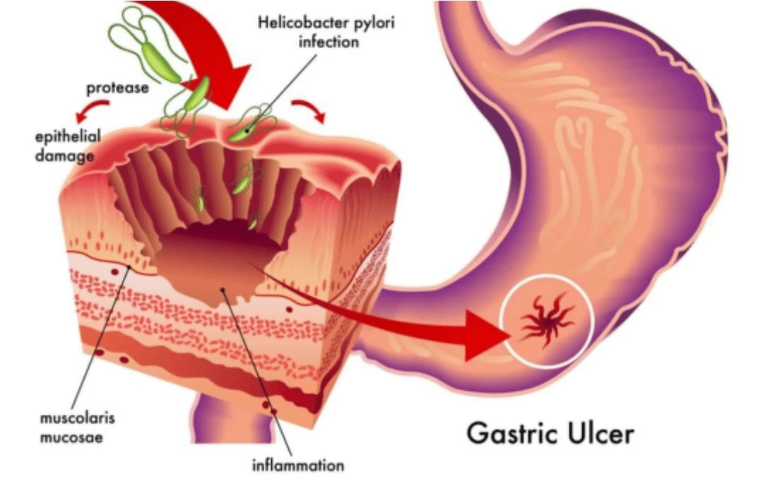 Illustration Of Stomach And Inner Layer Of Stomach With Gastric Ulcer And Infected With Helicobacter Pylori Bacteria
