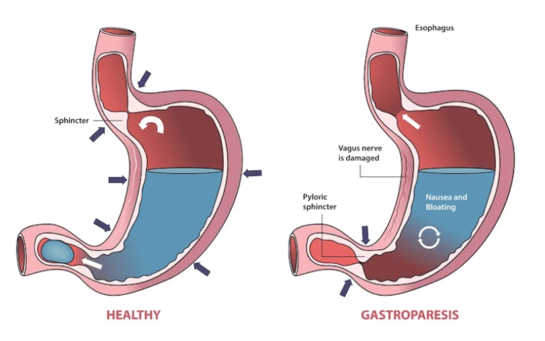 Illustration Of A Healthy Stomach And A Stomach With Gastroparesis