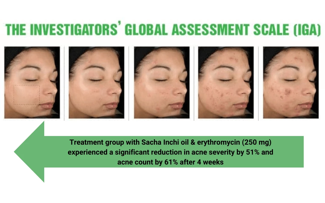 acne-severity-comparison-from-severe-to-fully-cleared-face-after-sacha-inchi-oil-consumption